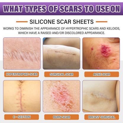 Silicone Scar Sheets, Medical Grade Silicone Scar Tape for Old & New Scars | Scar Tape for Surgical, Hypertrophic, Keloid, C-Section, Burn Scars, Reusable Professional Scars Removal (1.6"X59" Roll-1.5M)